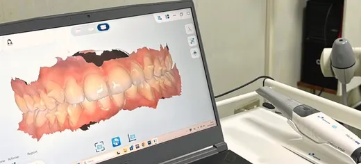 Una scansione 3D dei denti sullo schermo, accanto allo scanner intraorale